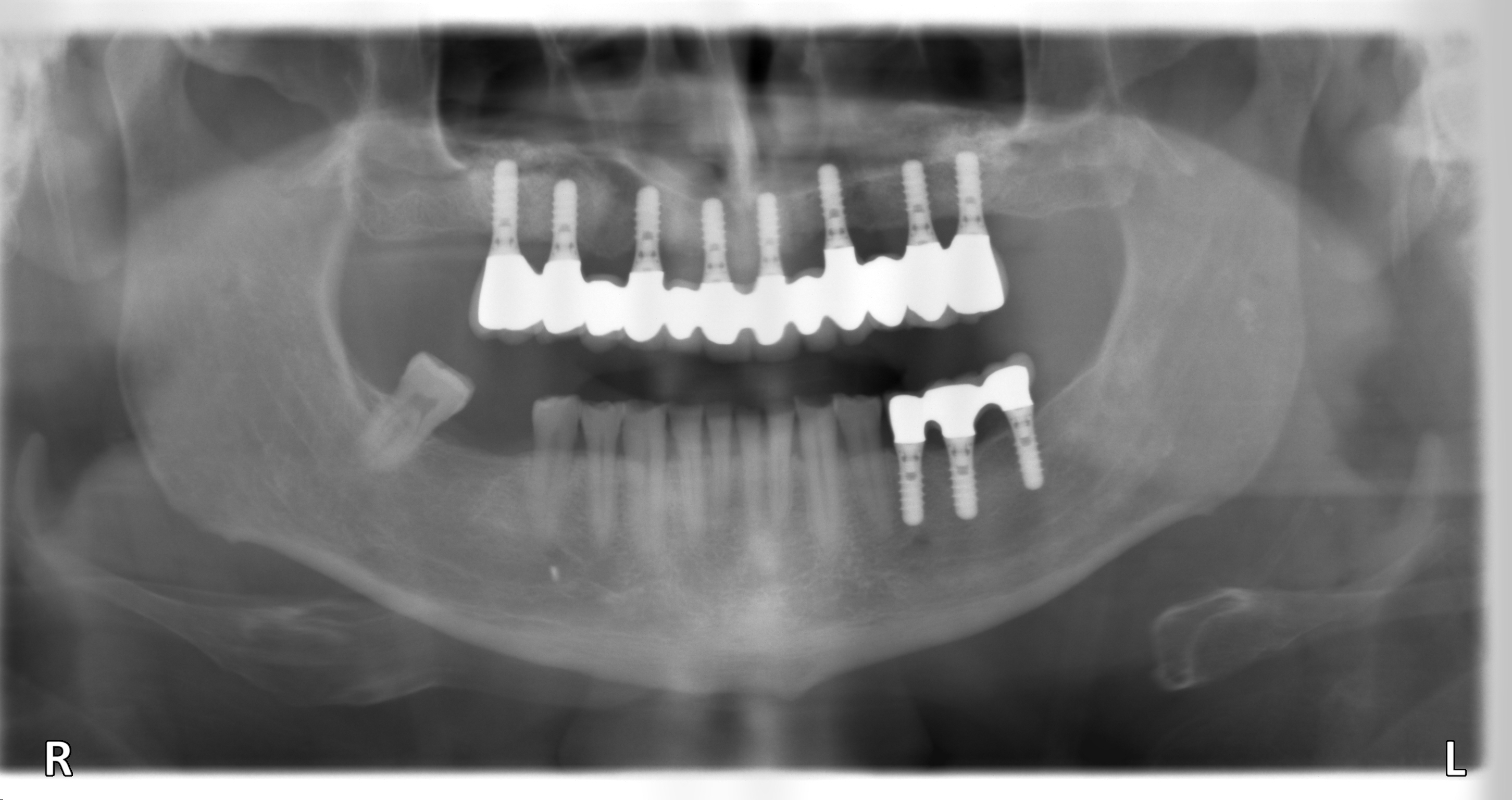 Zahnarzt Hildesheim setzt mehr als 2000 Implantate jährlich