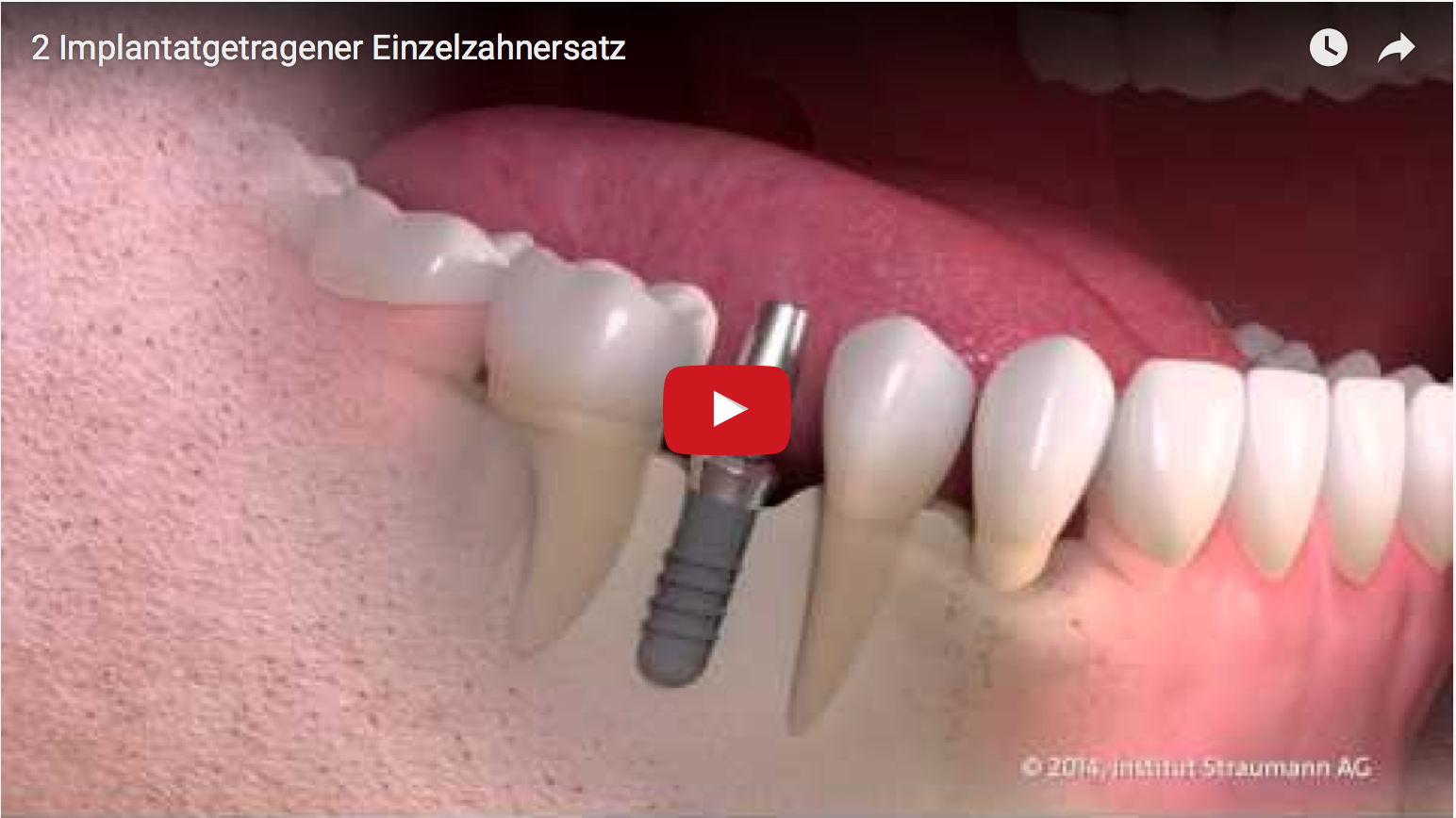 Festsitzende, implantatgetragene Zähne sehen nicht nur aus wie eigene, sondern fühlen sich auch so an. Implantat, neuer Zahn und Weichgewebe bilden eine harmonische Einheit.