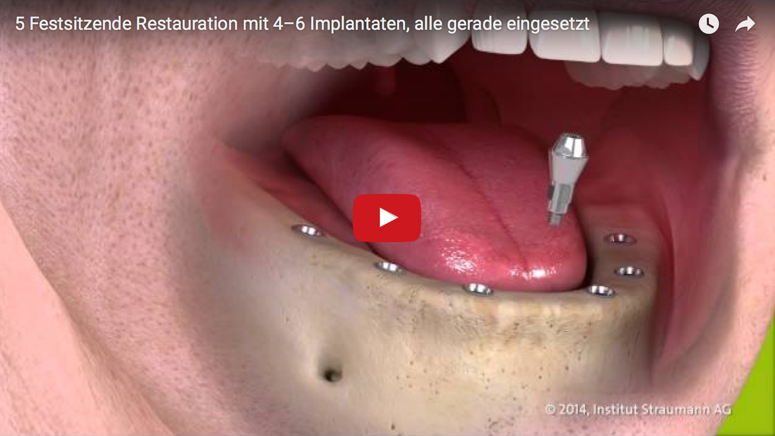 Patienten mit zahnlosem Kiefer haben zwei Möglichkeiten zur Auswahl: eine auf Implantaten fest verschraubte Zahnreihe oder eine herausnehmbare, implantatgetragene Prothese.