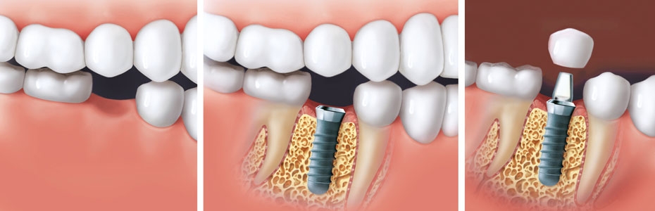 Bilderreihe zum Implantationsverfahren