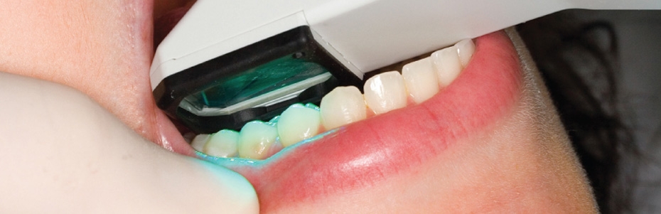 Intra-orales Scansystem ermöglicht präzise, digitale Abbildungen ohne unangenehme Abdrucknahme mit Silikon und Abformlöffel.