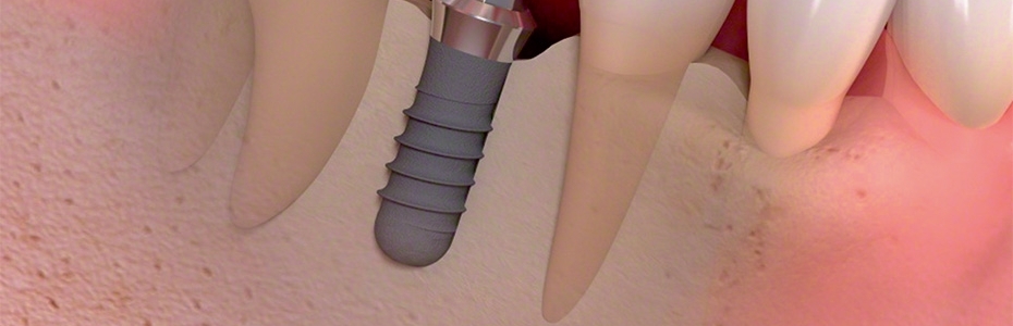 Mehr als 25 000 erfolgreich gesetzte Implantate