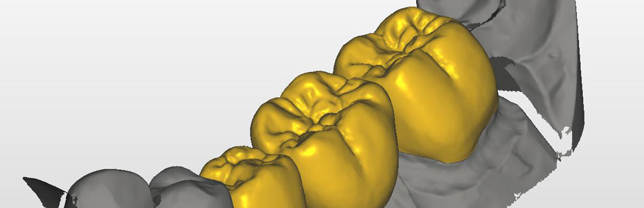 Individuelle Implantataufbauten, weil Zähne nicht rund sind.