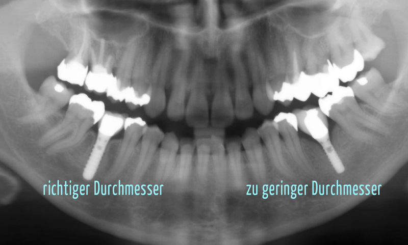 Falscher Implantatdurchmesser
