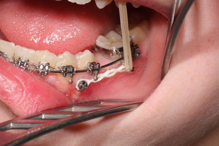 Gaumenimplantat. Zahnarzt Hildesheim