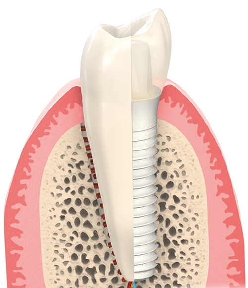 Keramik Implantat Zahnarzt Hildesheim