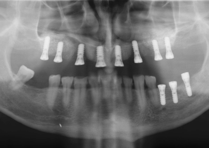 Zahnarzt Hildesheim. Oralchirurgie. Mund Kiefer Gesichtschirurgie Dr. Thorsten Bettin.
