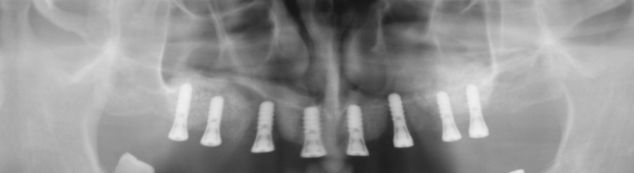 Zahnarzt Hildesheim sorgt mit Implantaten für den sicheren Halt der Zähne