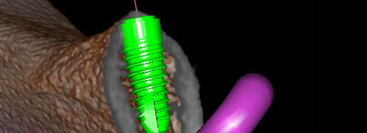 Dreidimensionale, plastische Darstellung unterstützt bei Diagnose, Planung und Insertion der Implanta